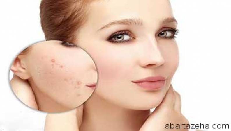 درمان جوش های ریز زیر پوست