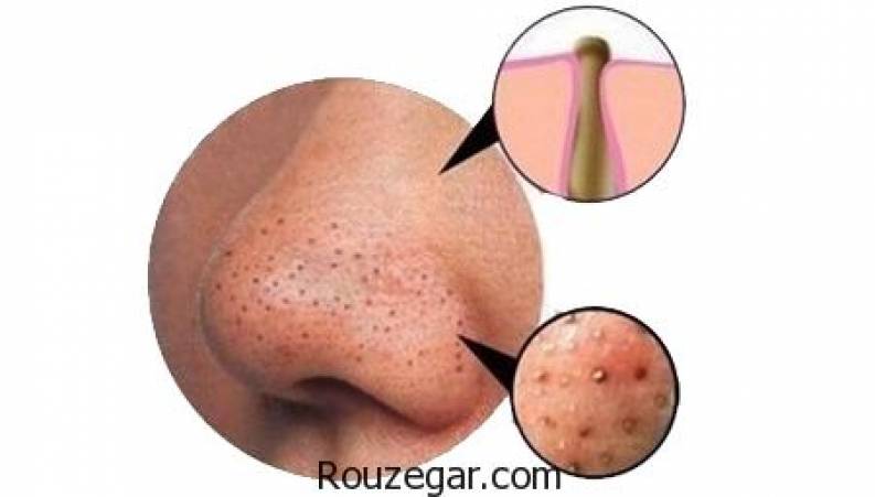 درمان جوش های سرسیاه بینی