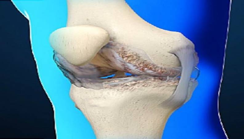 نکاتی که باید درباره ی آرتروز بدانید