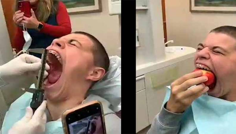 این پسر دهان گشادترین فرد در جهان ثبت شده در گینس را ببینید