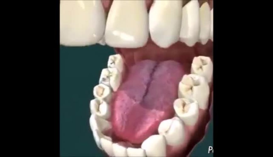 انیمیشن پرکردگی و ترمیم پوسیدگی دندان