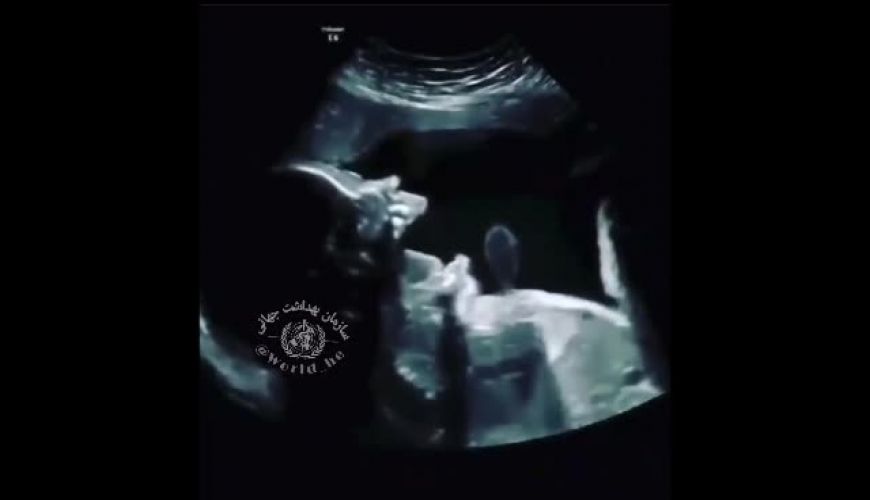 تاحالا خمیازه جنین در شکم مادر دیده بودین؟